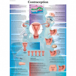 Planche anatomique - La contraception