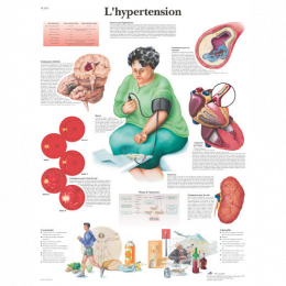 Planche Anatomique sur l'hypertension