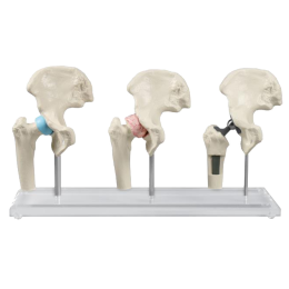Modèle anatomique du joint de hanche (sain, malade, implant) Erler Zimmer